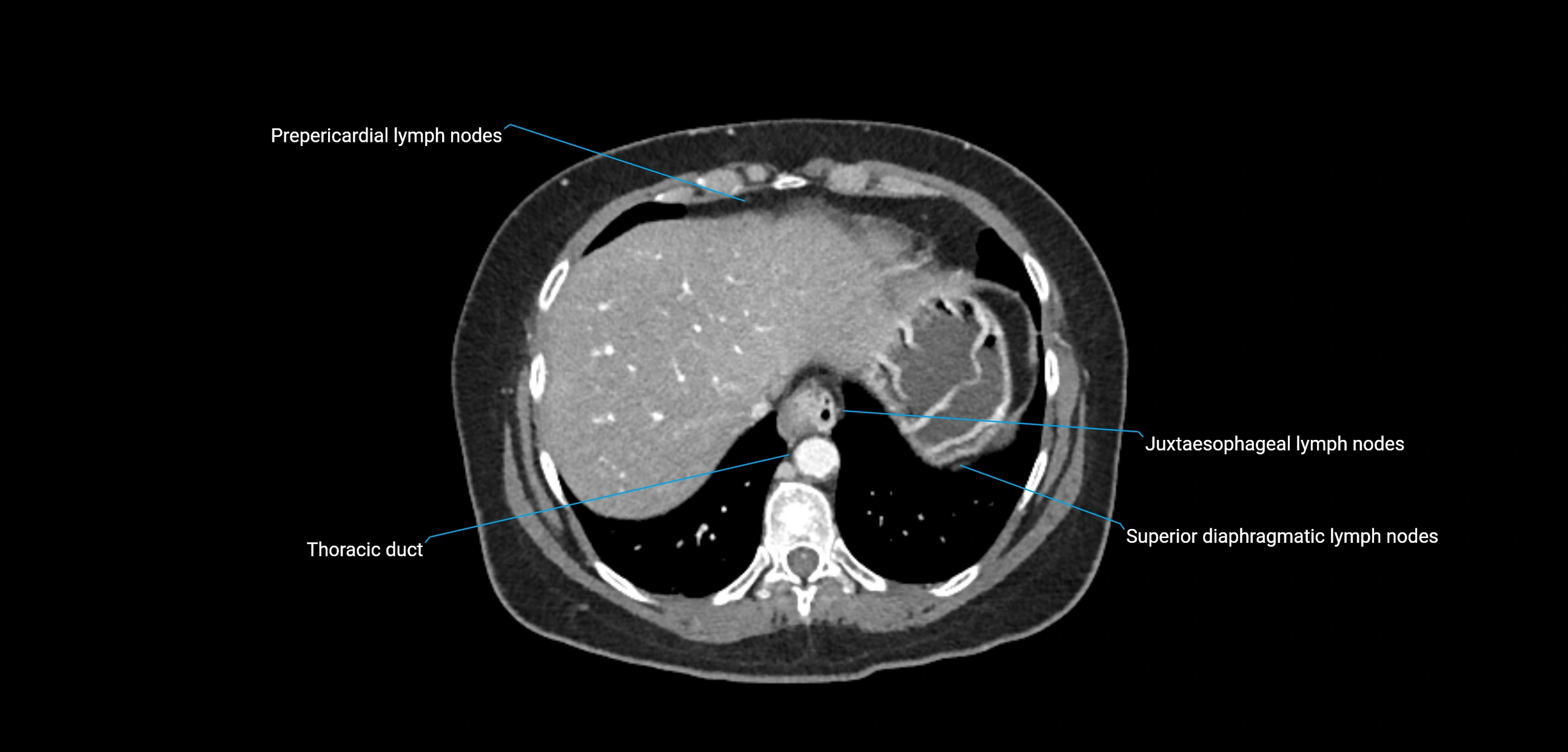 CT ct abdominal lymph nodes  axial cross sectional anatomy  enchanced radiology image -img-00002-00078.webp